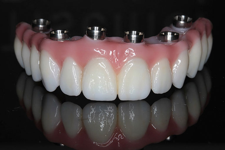 implantes-dentales.004